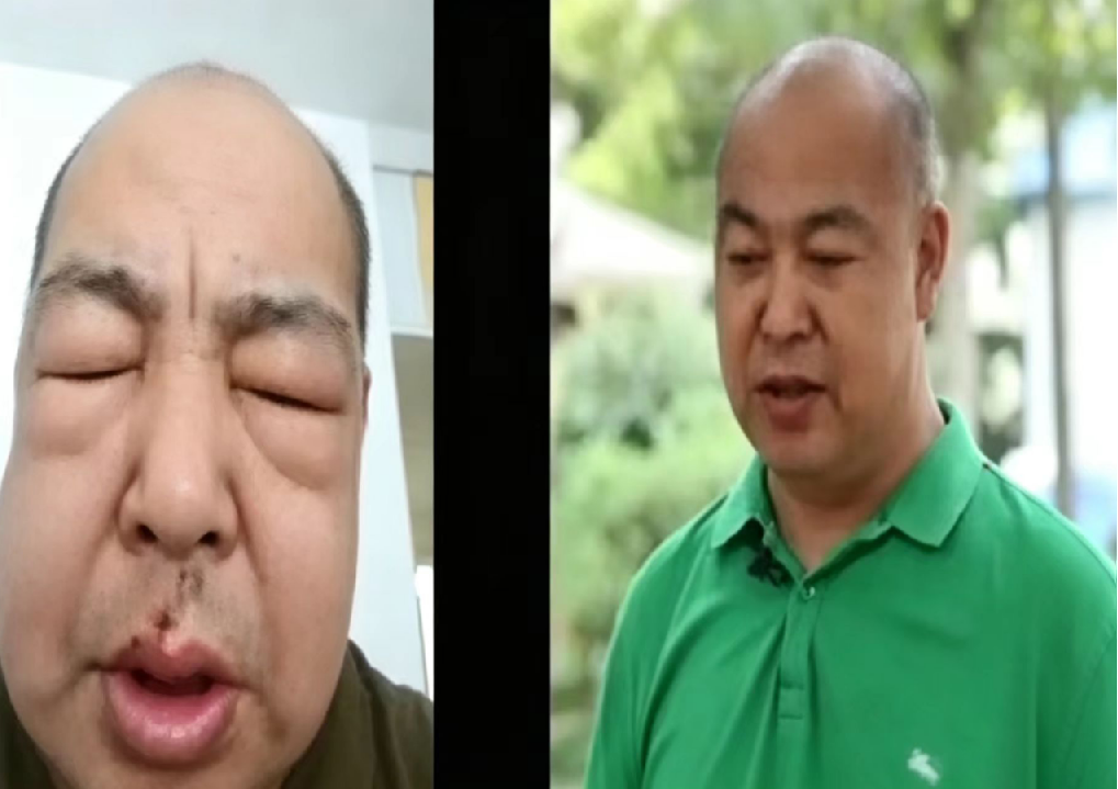 治疗前全身高度水肿