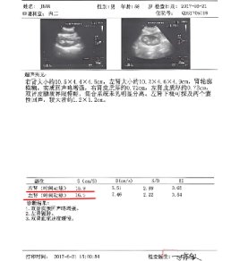 JEAN入院时的彩超报告单